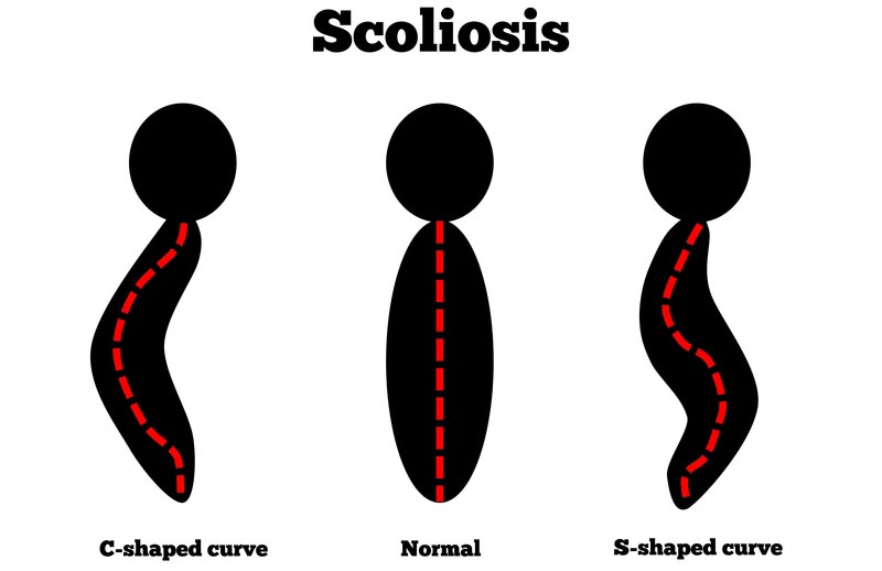 Santa Cruz, CA scoliosis treatment